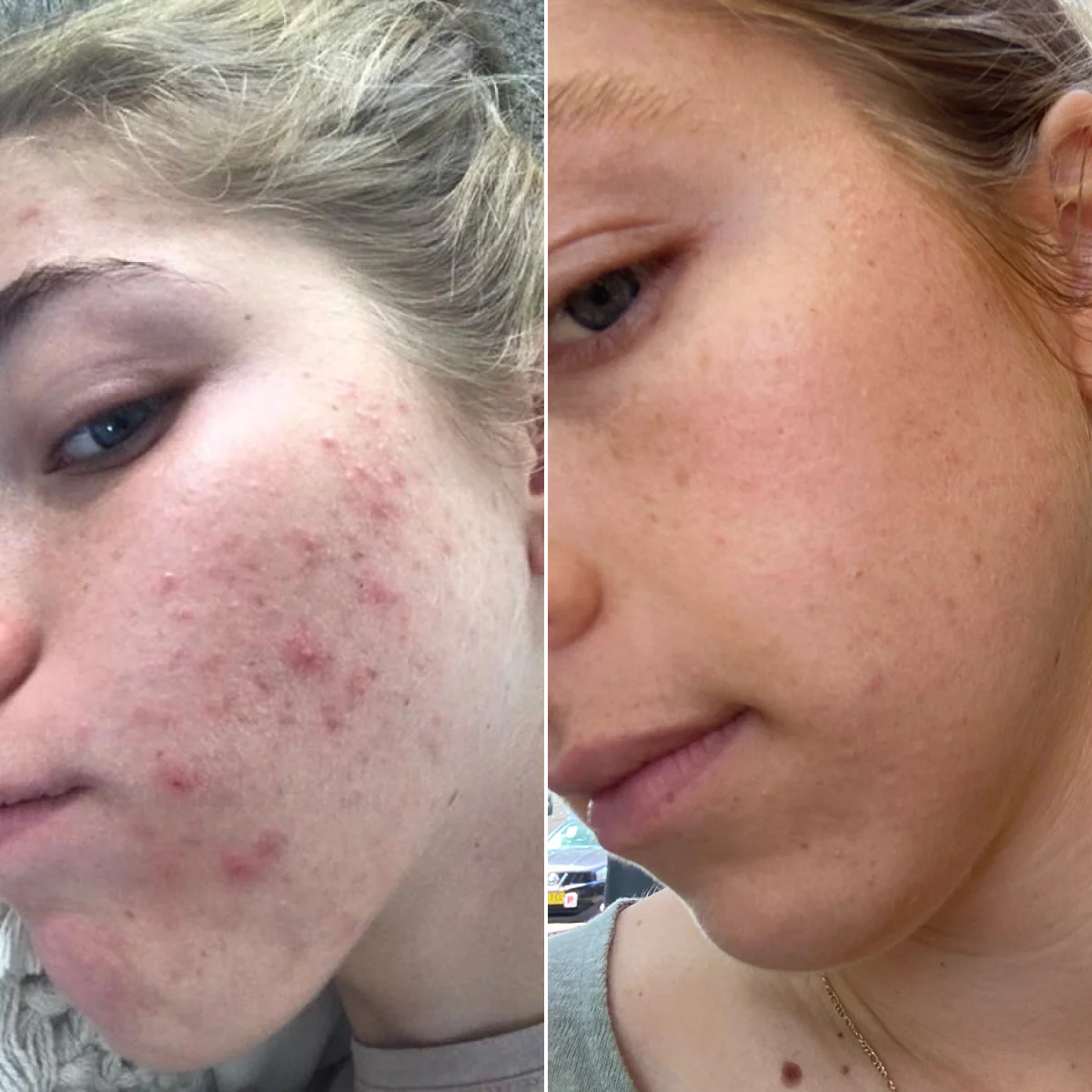 3 Step Skin Care Bundle - Image 7